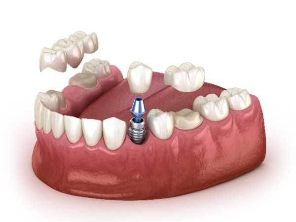 dental implants Chippenham