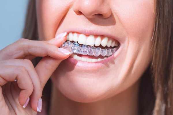 invisalign Chippenham